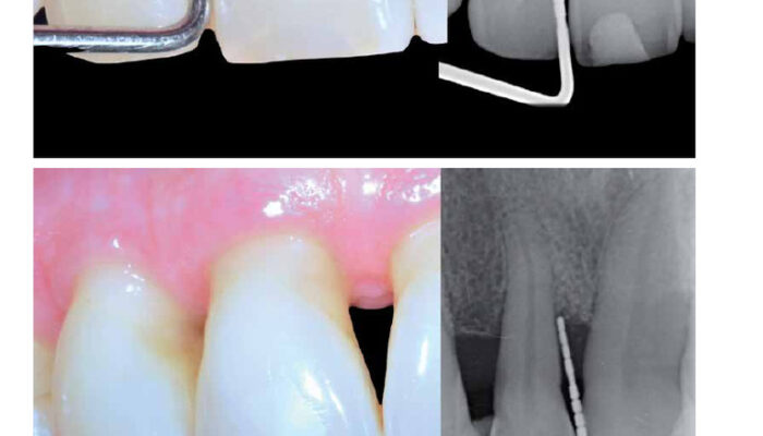 Strain Revealed: Combined Techniques Map the Pressure Within