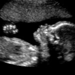 Crystal Phase Change Saves Lives: Warming Premature Babies with Science