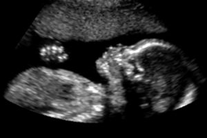 Crystal Phase Change Saves Lives: Warming Premature Babies with Science