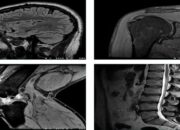 What is Magnetic Resonance Imaging (MRI)?