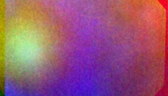 Dineutron Emission: A Twin-Particle Phenomenon Observed for the First Time