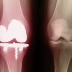 Dissolvable Glass: The Key to Fixing Bones?