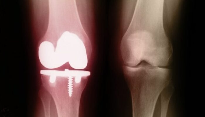Dissolvable Glass: The Key to Fixing Bones?