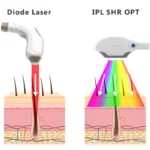 What is the difference between a diode and a true laser?