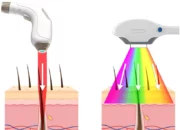 What is the difference between a diode and a true laser?