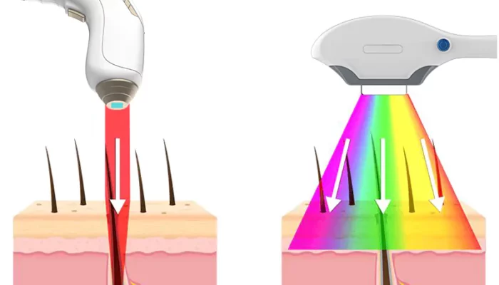 What is the difference between a diode and a true laser?